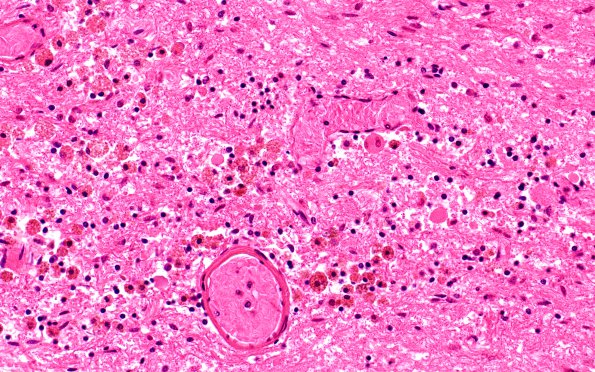 11A6 Sickle Cell Anemia, hypoxia-ischemia, (Case 11) N4 40X