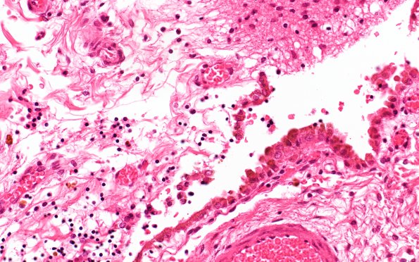 11A8 Sickle Cell Anemia, hypoxia-ischemia, (N9 Case 11) Choroid plexus hemosiderin 40X