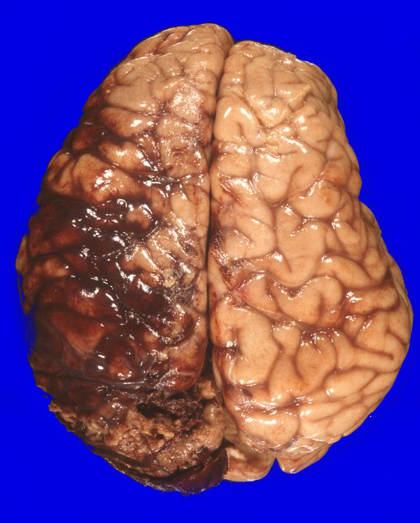 12A1 Hemorrhage Sickle cell (Case 12) gross 1 (2)