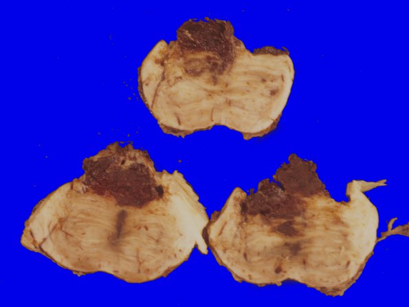 12A3 Hemorrhage Sickle cell (Case 12) gross 1