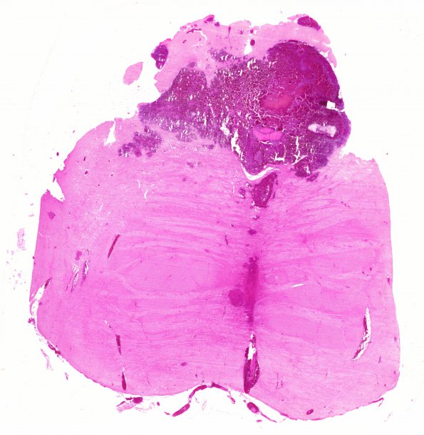 12B1 Hemorrhage Sickle cell (Case 12) N8 H&E 20X