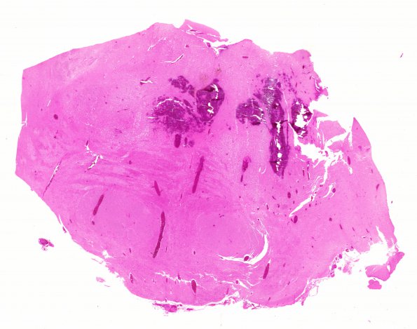 12B2 Hemorrhage Sickle cell (Case 12) N6 H&E 20X