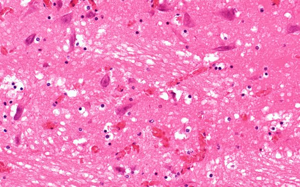 12B4 Hemorrhage Sickle cell (Case 12) N7 H&E 40X