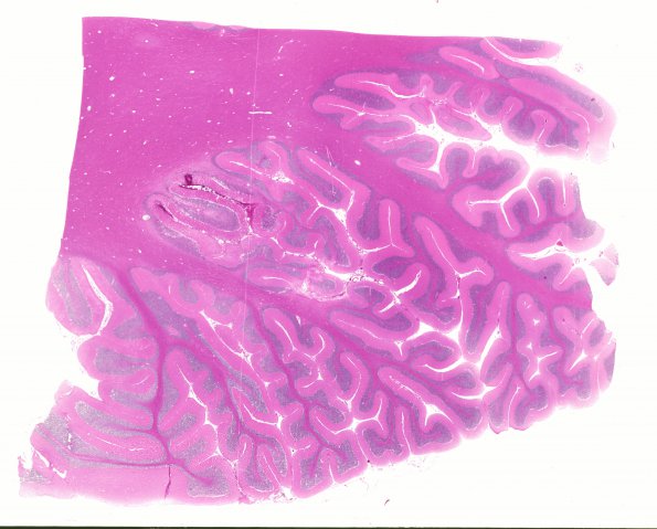 12C1 Hemorrhage Sickle cell (Case 12) N11 H&E WM