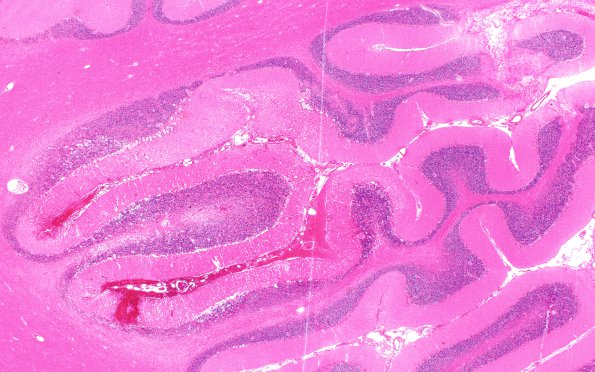 12C2 Hemorrhage Sickle cell (Case 12) N9A H&E 2X