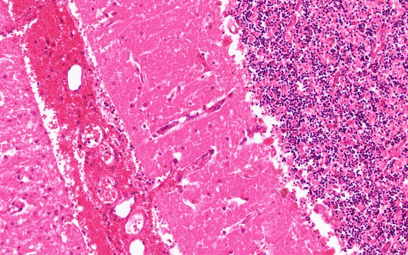 12C3 Hemorrhage Sickle cell (Case 12) N9A H&E 20X 2