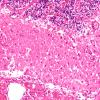 12C4 Hemorrhage Sickle cell (Case 12) N9A H&E 20X