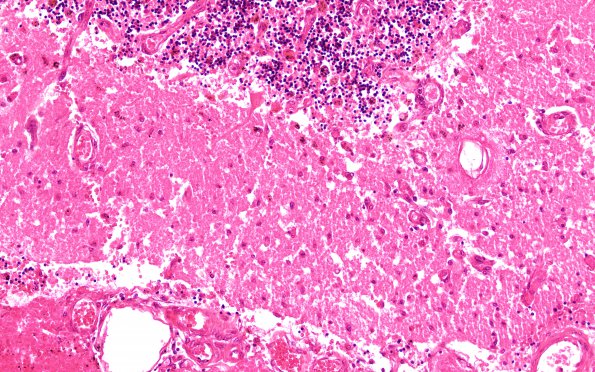 12C4 Hemorrhage Sickle cell (Case 12) N9A H&E 20X