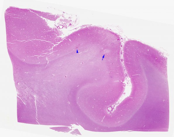 1B1 Sickle Cell Anemia (Case 1) H&E WM copy