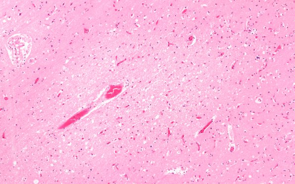 1B1C Sickle Cell Anemia (Case 1) N1 H&E 10X