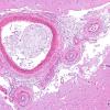 1B2 Sickle Cell Anemia (Case 1) H&E 2