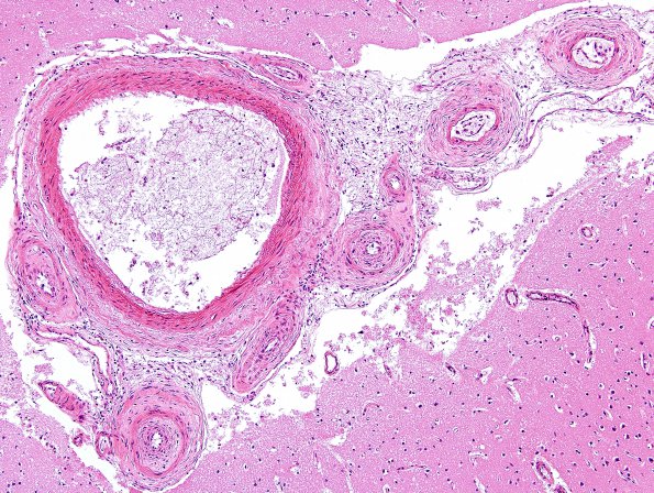 1B2 Sickle Cell Anemia (Case 1) H&E 2