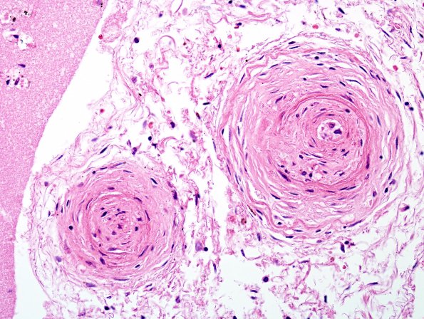 1B3 Sickle Cell Anemia (Case 1) H&E 1