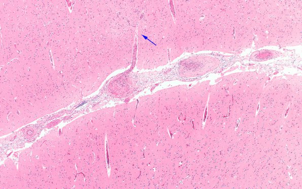 1B4A  Sickle Cell Anemia (Case 1) N1 H&E 4X copy - Copy