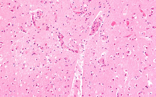 1B4B  Sickle Cell Anemia (Case 1) N1 H&E 20X