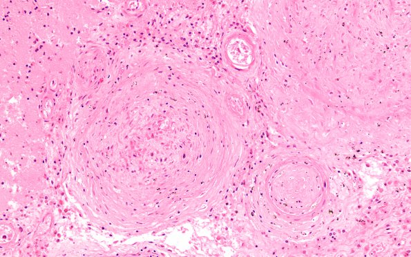 1B5 Sickle Cell Anemia (Case 1) N11 H&E 20X