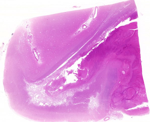 1B6  Sickle Cell Anemia (Case 1) N13 H&E 2WM