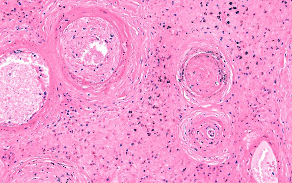 1B9  Sickle Cell Anemia (Case 1) N13 H&E 20X