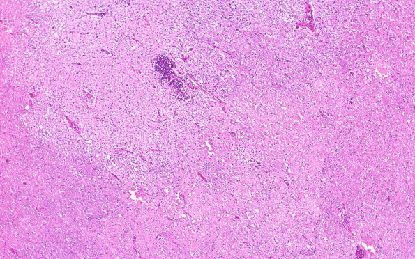 2B1 Sickle cell anemia (Case 2) Infarcts N1 H&E 4X 1