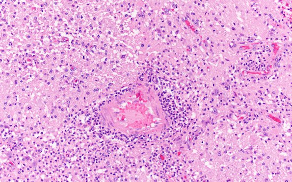 2B2 Sickle cell anemia (Case 2) Infarcts H&E 3