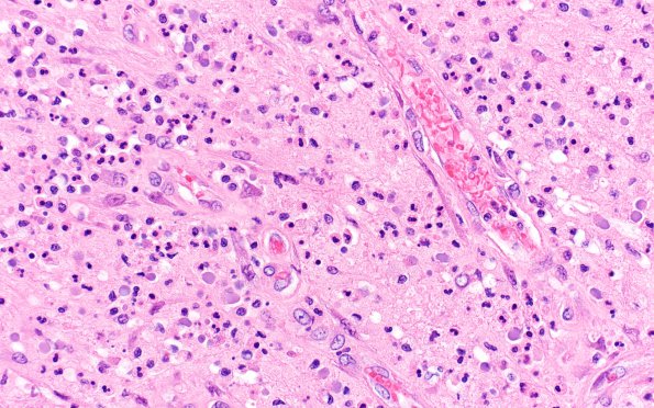 2B3 Sickle cell anemia (Case 2) Infarcts H&E 2