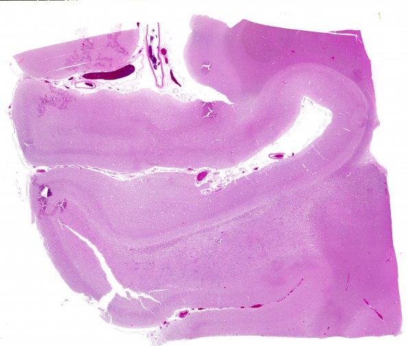 2B5 Sickle cell anemia (Case 2) Infarcts N5 H&E WM