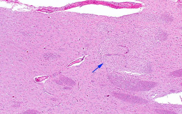 2B6 Sickle cell anemia BG (Case 2) Infarcts H&E 4 copy