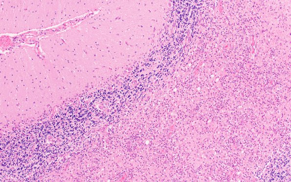 2C2 Sickle cell anemia (Case 2) Infarcts H&E 9