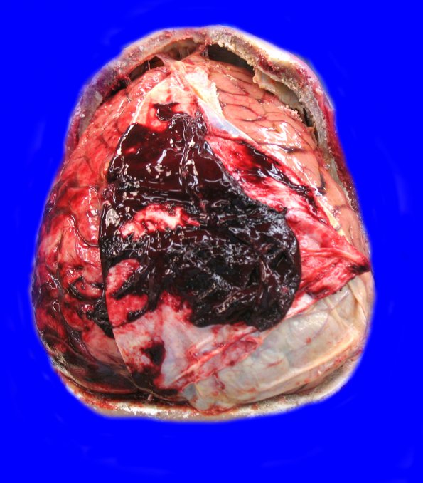 3A1 Sickle Cell Anemia (Case 3) A_1