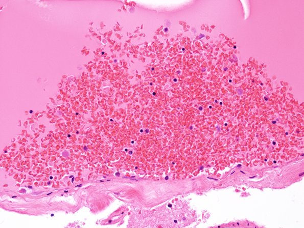 3B2 Sickle Cell Anemia (Case 3) H&E 1