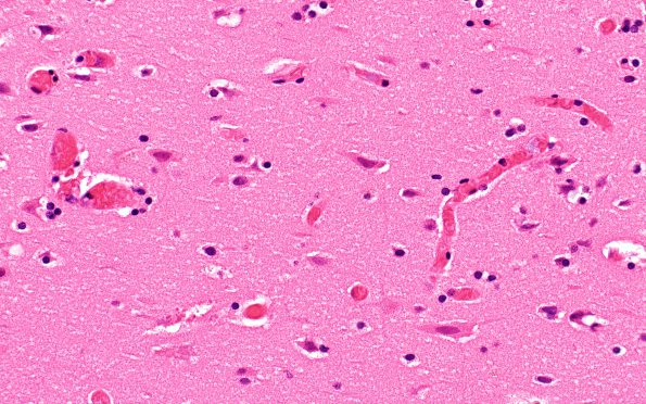 3B3 Sickle Cell Anemia (Case 3) H&E 40X