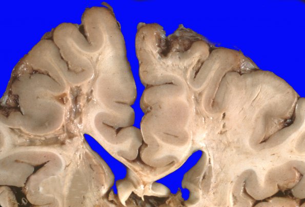 4A1 Infarct, Sickle Cell Dz (Case 4)