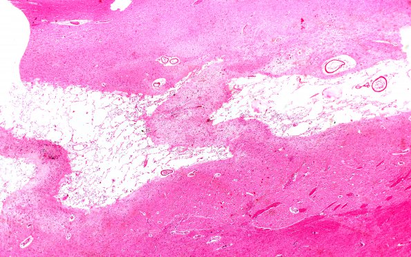 4B1 Hemorrhage Sickle cell (Case 4) 4 H&E 2X