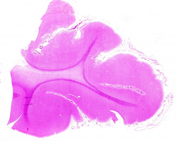 4B2 Hemorrhage Sickle cell (Case 4) WM 2