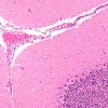 4B5 Hemorrhage Sickle cell (Case 4) H&E cerebellum 10X