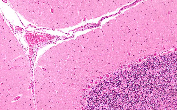 4B5 Hemorrhage Sickle cell (Case 4) H&E cerebellum 10X