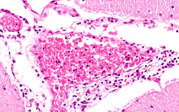 4B6 Hemorrhage Sickle cell (Case 4) H&E cerebellum 40X