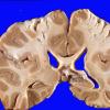 6 Infarct, Watershed,  Sickle Cell Dz (Case 6) a