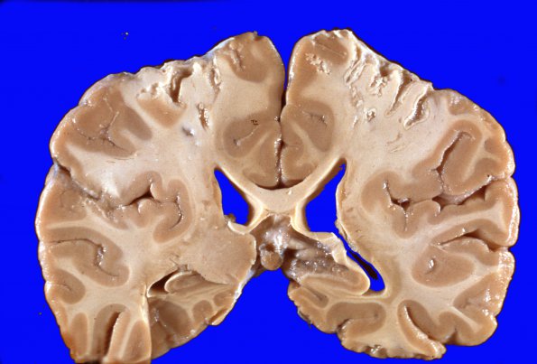 6 Infarct, Watershed,  Sickle Cell Dz (Case 6) a