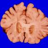 10A1 Infarcts, arteriolosclerosis (Case 10) Gross 2