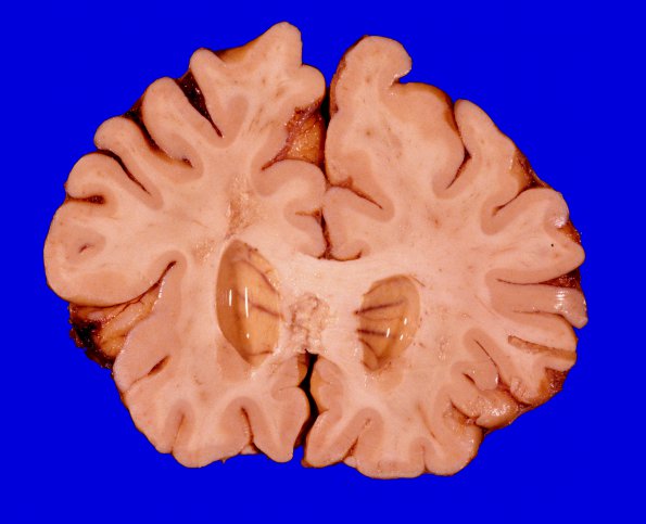 10A1 Infarcts, arteriolosclerosis (Case 10) Gross 2