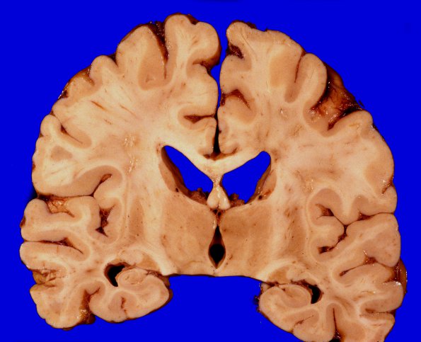 10A2 Infarcts, arteriolosclerosis (Case 10) Gross 1