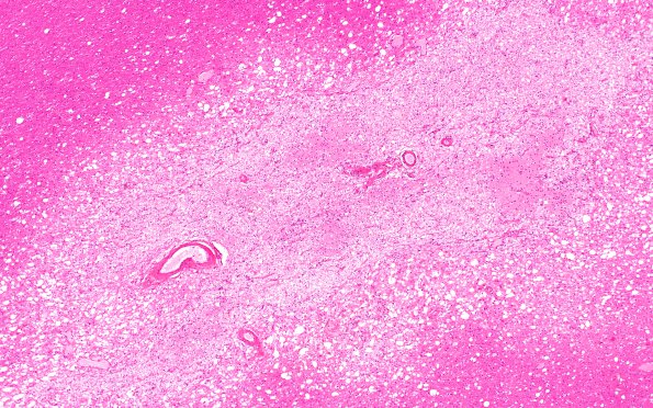 10B2 Infarcts, arteriolosclerosis (Case 10) N12 H&E 4X 2