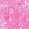 10B4 Infarcts, arteriolosclerosis (Case 10) N12 H&E 4X