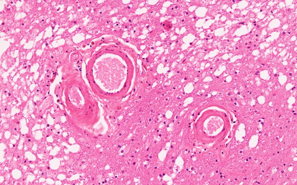 10B4 Infarcts, arteriolosclerosis (Case 10) N12 H&E 4X