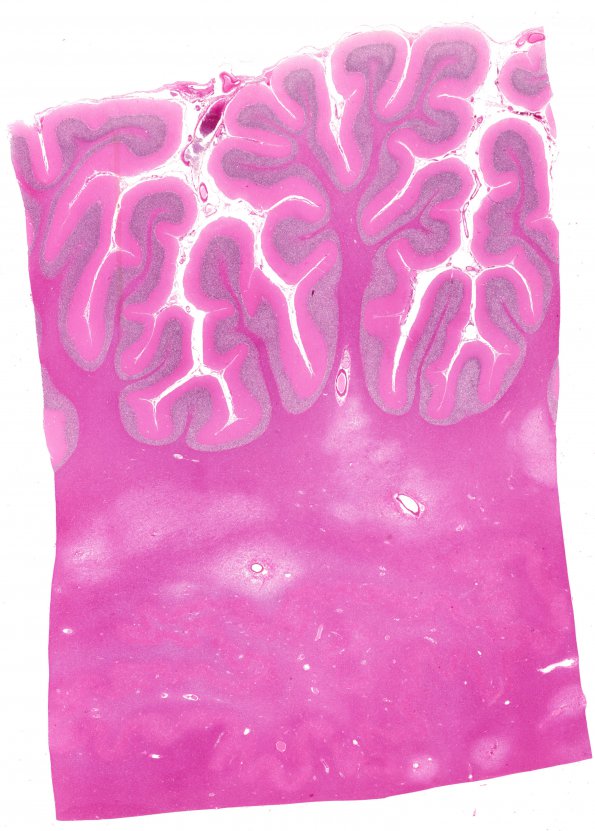 10B7 Infarcts, arteriolosclerosis (Case 10) N9 H&E WM