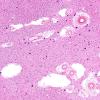 11A2 Arteriolosclerosis, occipital lobe (Case 11) H&E 3