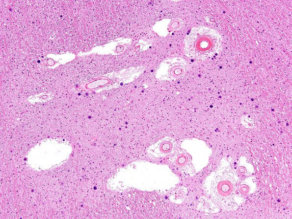 11A2 Arteriolosclerosis, occipital lobe (Case 11) H&E 3