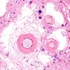 11A3 Arteriolosclerosis, occipital lobe (Case 11) H&E 1