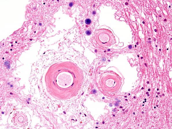 11A3 Arteriolosclerosis, occipital lobe (Case 11) H&E 1